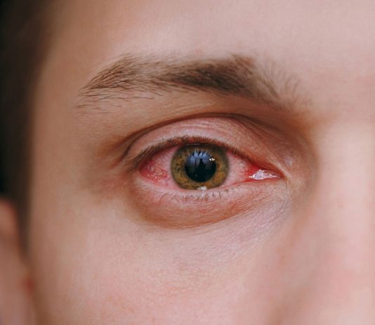 Konjonktivit Acil Yaklaşım