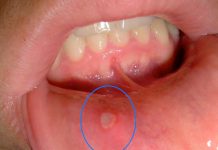 Aftöz Ülser (Aft) (Somatit) Acil Yaklaşım