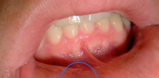 Aftöz Ülser (Aft) (Somatit) Acil Yaklaşım