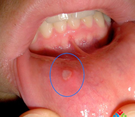 Aftöz Ülser (Aft) (Somatit) Acil Yaklaşım