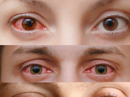 Viral Konjonktivitler Acil Yaklaşım