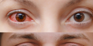 Viral Konjonktivitler Acil Yaklaşım