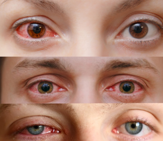 Viral Konjonktivitler Acil Yaklaşım