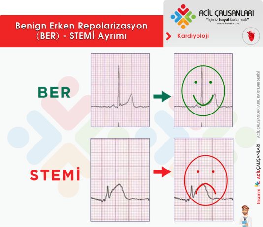 Benign Erken Repolarizasyon