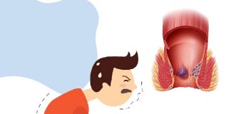 Hemoroid Acil Yaklaşım