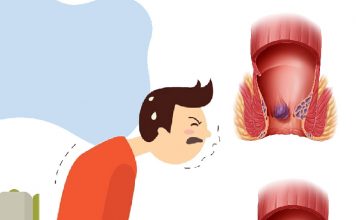 Hemoroid Acil Yaklaşım