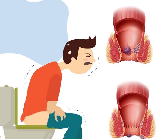 Hemoroid Acil Yaklaşım