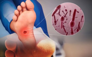 Tetanoz Hastalığına Acil Servis Yaklaşımı