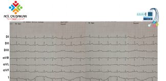 Aslanger EKG Paterni Olgu Sunumu