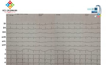 Aslanger EKG Paterni Olgu Sunumu