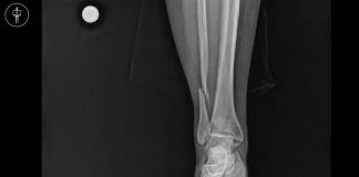 Cotton Kırığı Olgu Sunumu