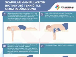 Skapular Manipulasyon (Rotasyon) Tekniği İle Omuz Redüksiyonu