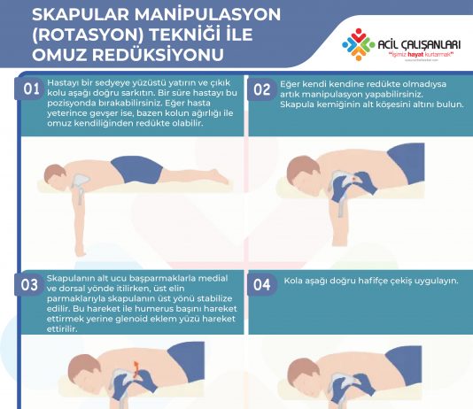Skapular Manipulasyon (Rotasyon) Tekniği İle Omuz Redüksiyonu