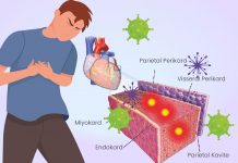 Miyokardit Acil Yaklaşım