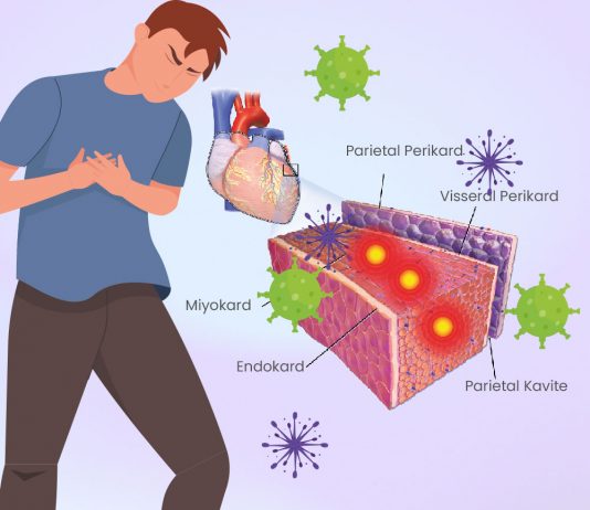 Miyokardit Acil Yaklaşım