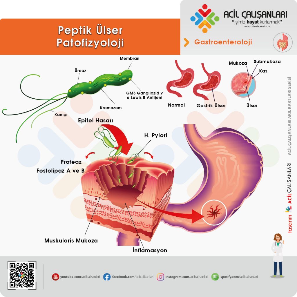 Peptik Ülser Hastalığı Acil Çalışanları