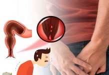 Anal Fissür Acil Yaklaşım