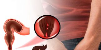 Anal Fissür Acil Yaklaşım