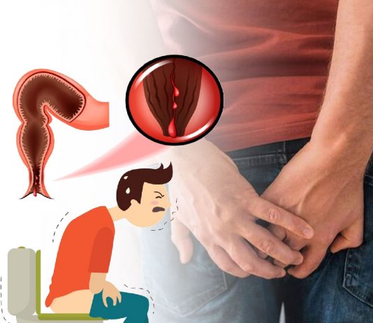 Anal Fissür Acil Yaklaşım