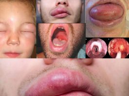 Anjioödem Acil Yaklaşım