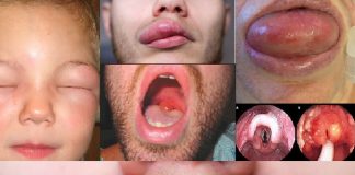 Anjioödem Acil Yaklaşım