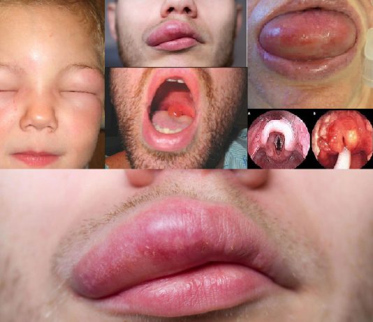 Anjioödem Acil Yaklaşım