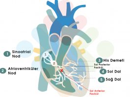 Sol Anterior Fasiküler Blok (LAFB)