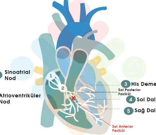 Sol Anterior Fasiküler Blok (LAFB)