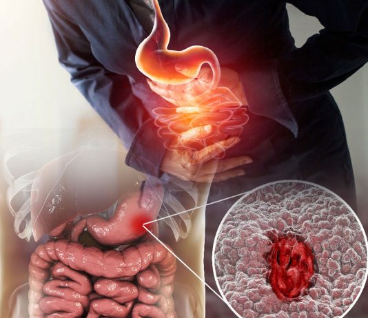 Peptik Ülser Hastalığı