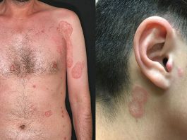 Tinea Korporis (Vücut Mantarı)