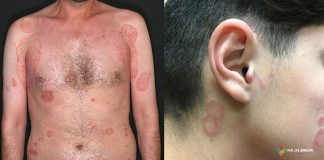 Tinea Korporis (Vücut Mantarı)