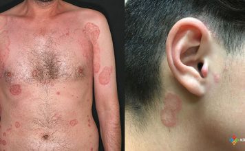 Tinea Korporis (Vücut Mantarı)