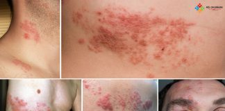 Zona (Herpes Zoster) Acil Yaklaşım