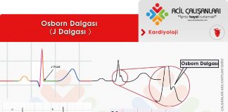 Osborn Dalgası (J Dalgası)