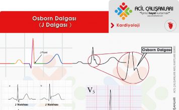 Osborn Dalgası (J Dalgası)