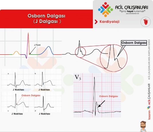 Osborn Dalgası (J Dalgası)