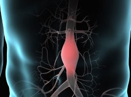 Abdominal Aort Anevrizmasına Acil Yaklaşım