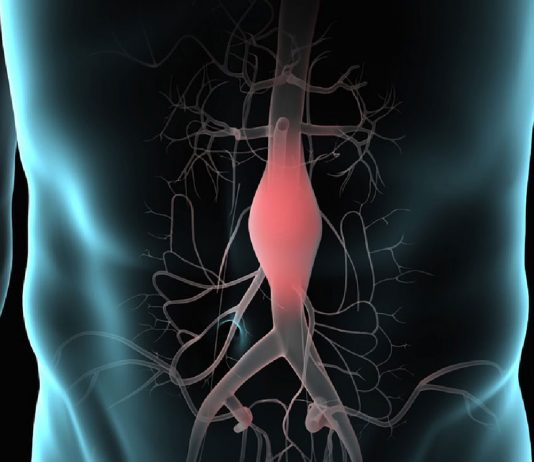 Abdominal Aort Anevrizmasına Acil Yaklaşım