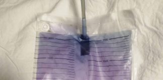 Mor İdrar Torbası Sendromu: Olgu Sunumu