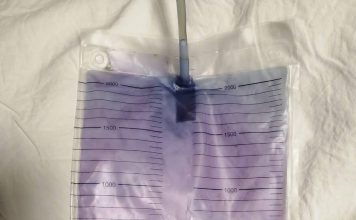 Mor İdrar Torbası Sendromu: Olgu Sunumu