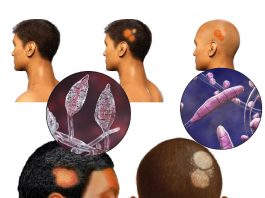 Tinea Kapitis (Saçlı Deri Mantarı)