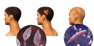 Tinea Kapitis (Saçlı Deri Mantarı)