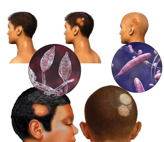 Tinea Kapitis (Saçlı Deri Mantarı)