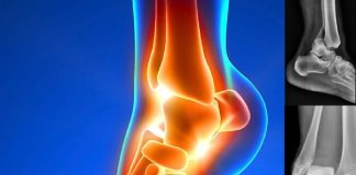 Ayak Bileği Çıkıklarına Genel Yaklaşım