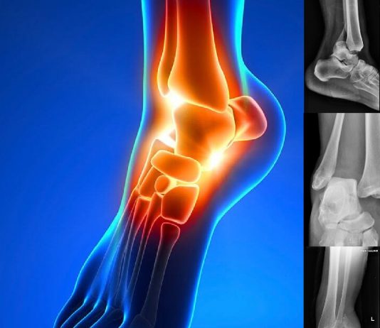 Ayak Bileği Çıkıklarına Genel Yaklaşım