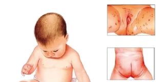 Pişik (Diaper Dermatit)