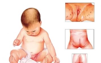 Pişik (Diaper Dermatit)