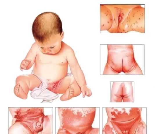Pişik (Diaper Dermatit)