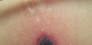 Ektima Gangrenozum Acil Yaklaşım