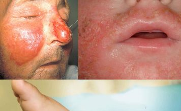 Erizipel (Yılancık) Acil Yaklaşım